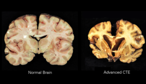A 'healthy' brain compared to one with advanced chronic traumatic encephalopathy (CTE), which is linked to early onset dementia